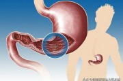 得了胃潰瘍，十二指腸潰瘍怎麽辦？