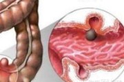 結腸炎有什麽症狀表現,結腸炎