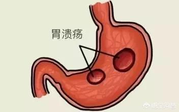 胃潰瘍與(yu) 十二指腸潰瘍在臨(lin) 床表現上有哪些異同<strong>胃潰瘍</strong>？