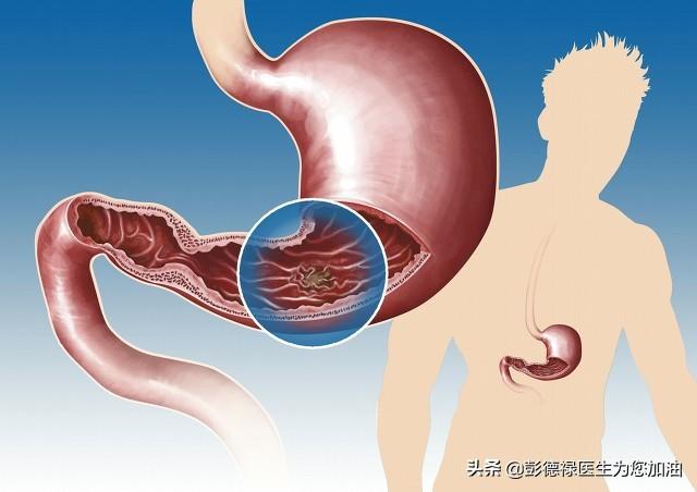 得了胃潰瘍<strong>胃潰瘍</strong>，十二指腸潰瘍怎麽(me) 辦？