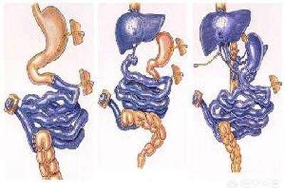 什麽(me) 是短腸綜合征<strong>腸病</strong>？