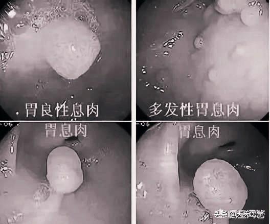 胃的常見疾病有哪些<strong>胃病</strong>？