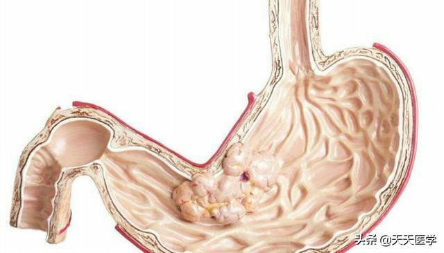 胃的常見疾病有哪些<strong>胃病</strong>？