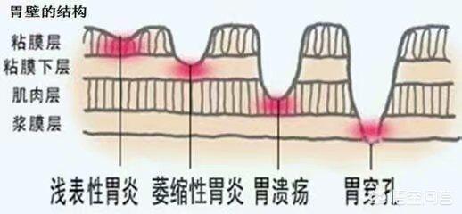胃不好有什麽(me) 症狀?胃病常見病因及症狀是什麽(me) ?該如何治療和護理<strong>胃病</strong>？