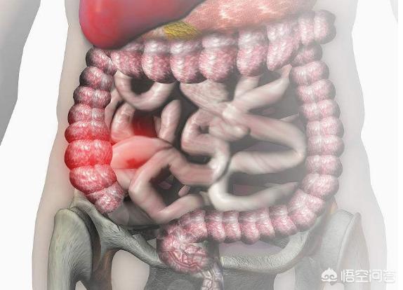 克羅恩病有哪些症狀<strong>腸道</strong>？有什麽(me) 治療的方法？