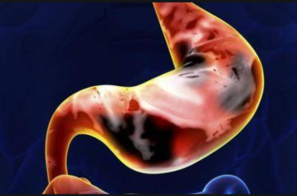 胃潰瘍該吃什麽(me) <strong>胃潰瘍</strong>?需要每天喝粥、吃麵條嗎?