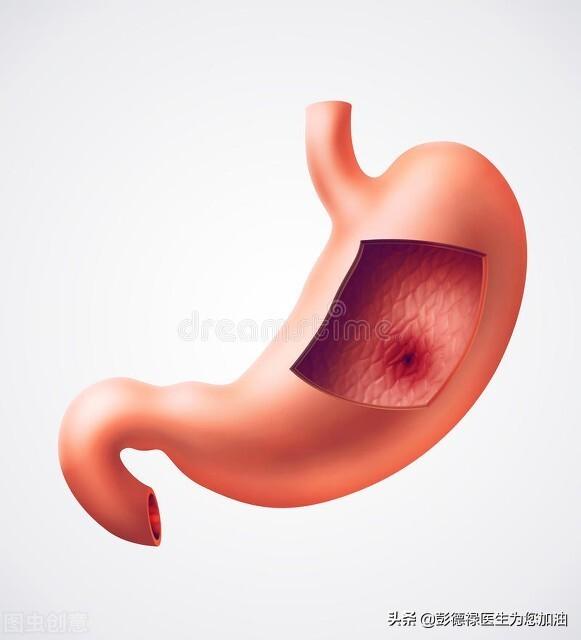 患上胃潰瘍的症狀是什麽(me) <strong></p>
<p>胃潰瘍</strong>？