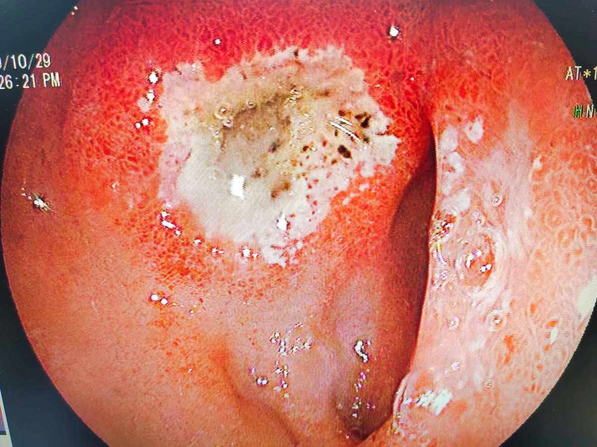 十二指腸十二指腸潰瘍