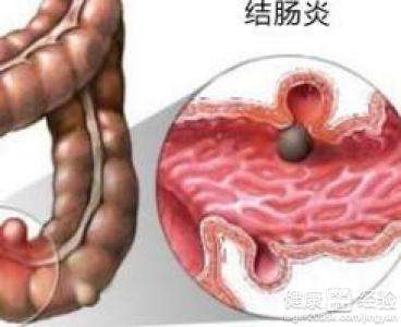 結腸炎有什麽(me) 症狀表現,結腸炎