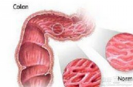 直腸炎直腸炎怎麽(me) 治療快速有效