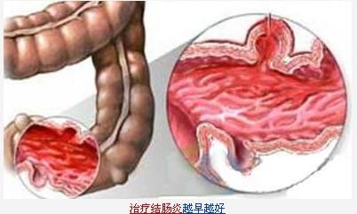 直腸炎直腸炎怎麽(me) 治療快速有效
